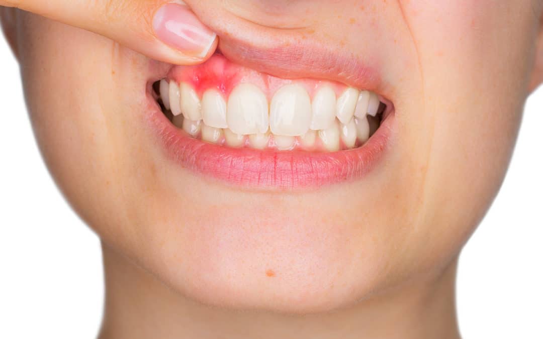 Preventing gum disease