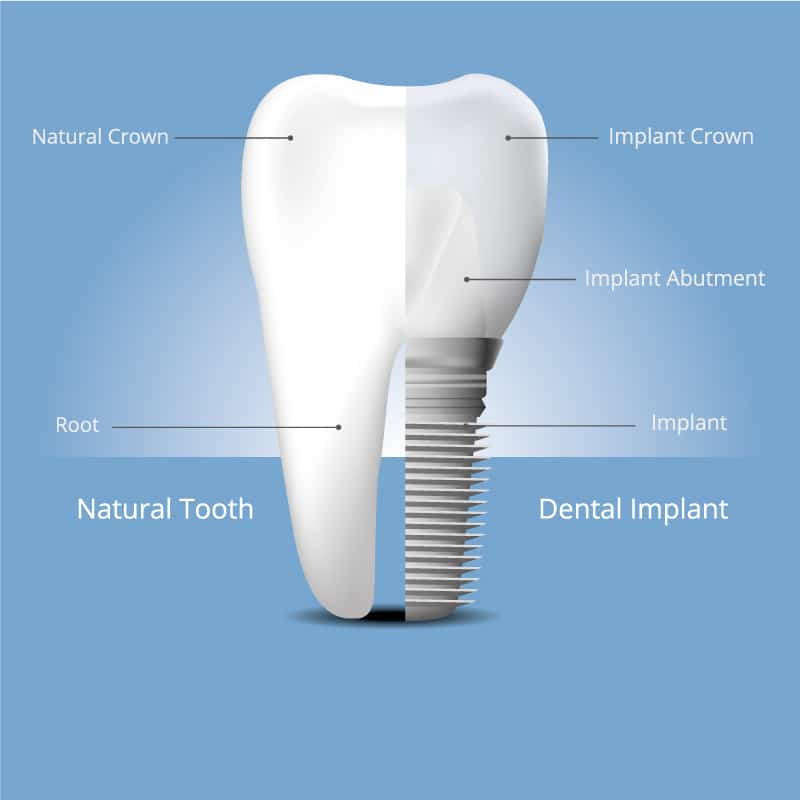 Dental Implants Portsmouth
