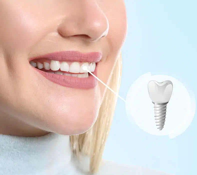 Dental implants