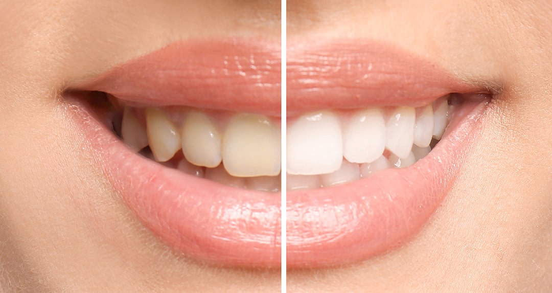 Teeth-Whitening-Result