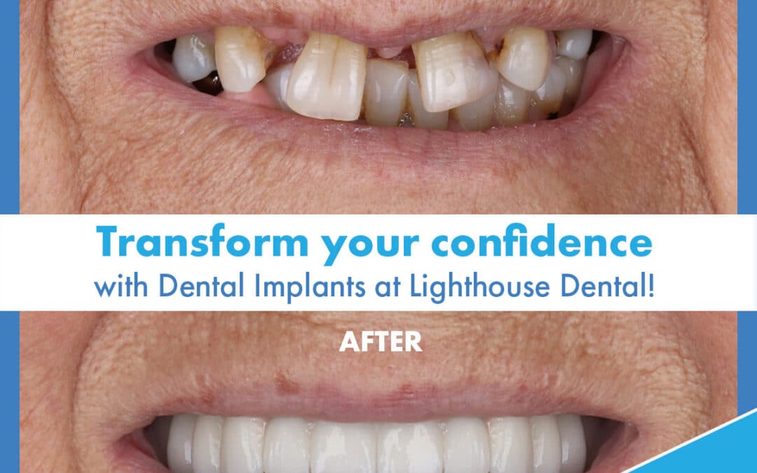 Rediscover Your Smile With Dental Implants