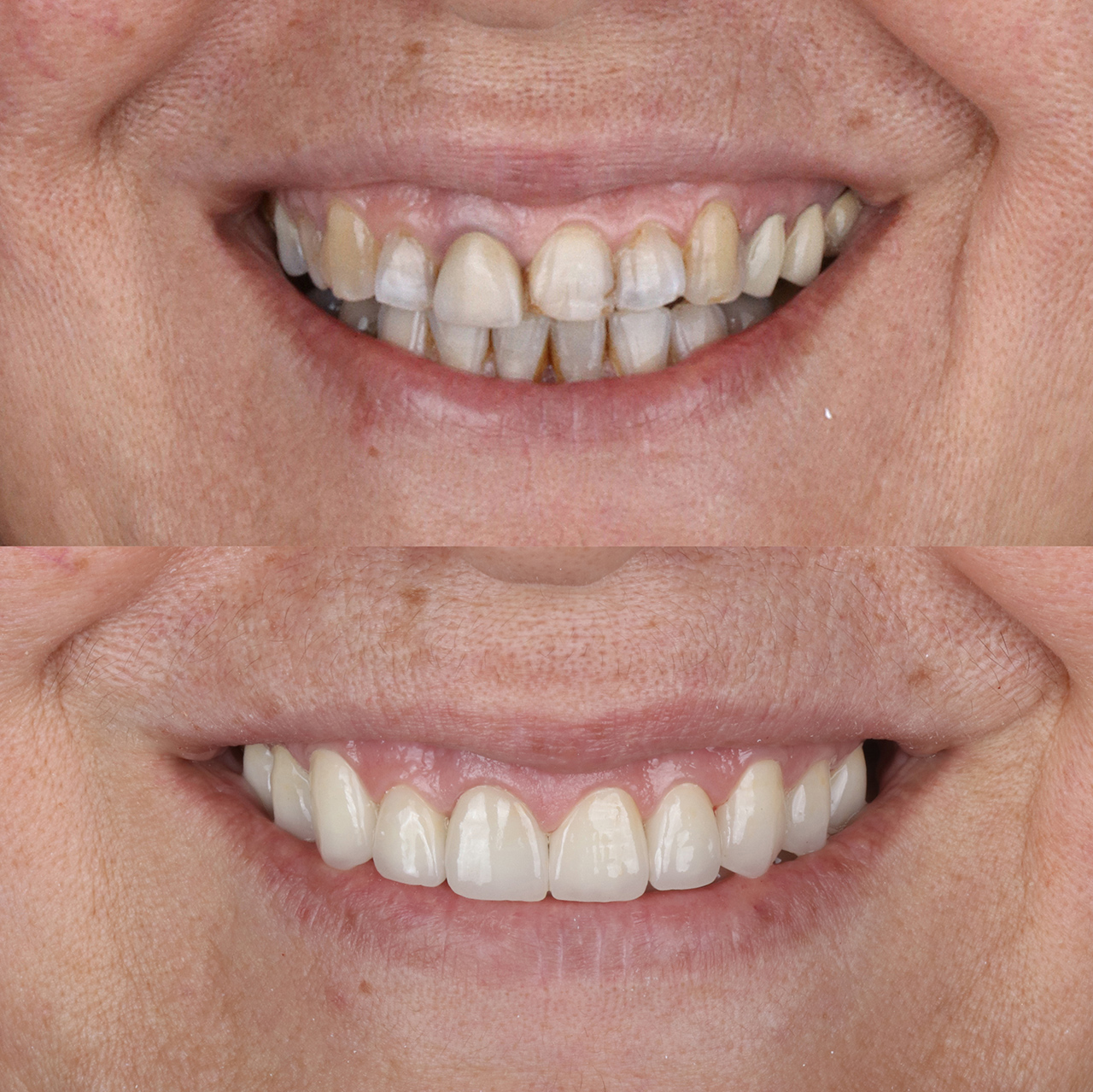 Emax-Dental-Crowns